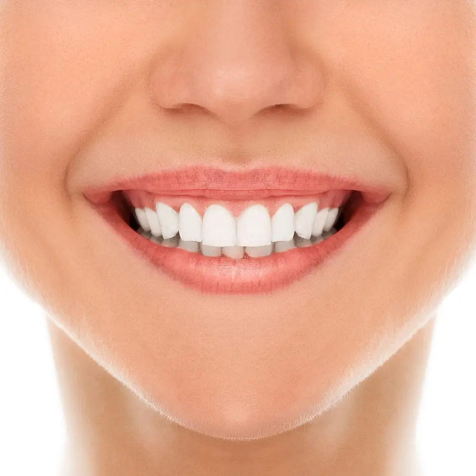 Primer plano de una sonrisa con carillas dentales