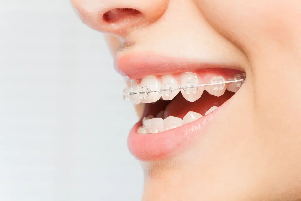 Sonrisa con brackets de ortodoncia