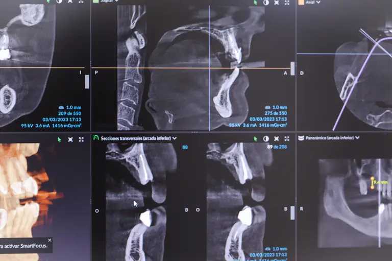 Radiografía 3D en la pantalla de la clínica